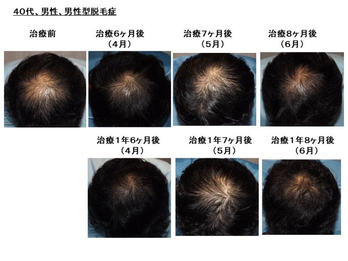 円形脱毛症　病院